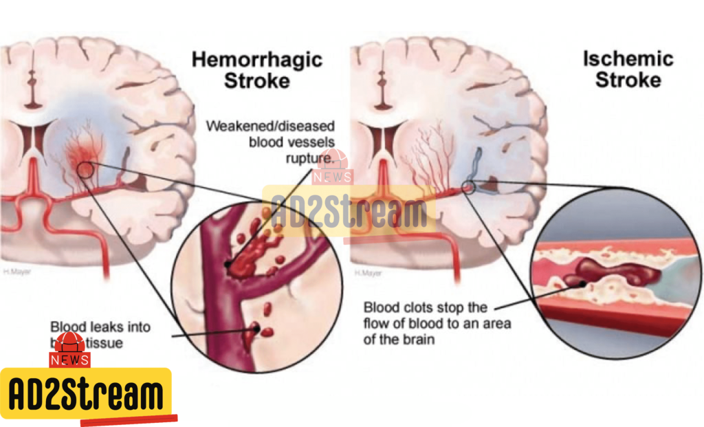 Ada dua jenis utama stroke iskemik dan hemoragik