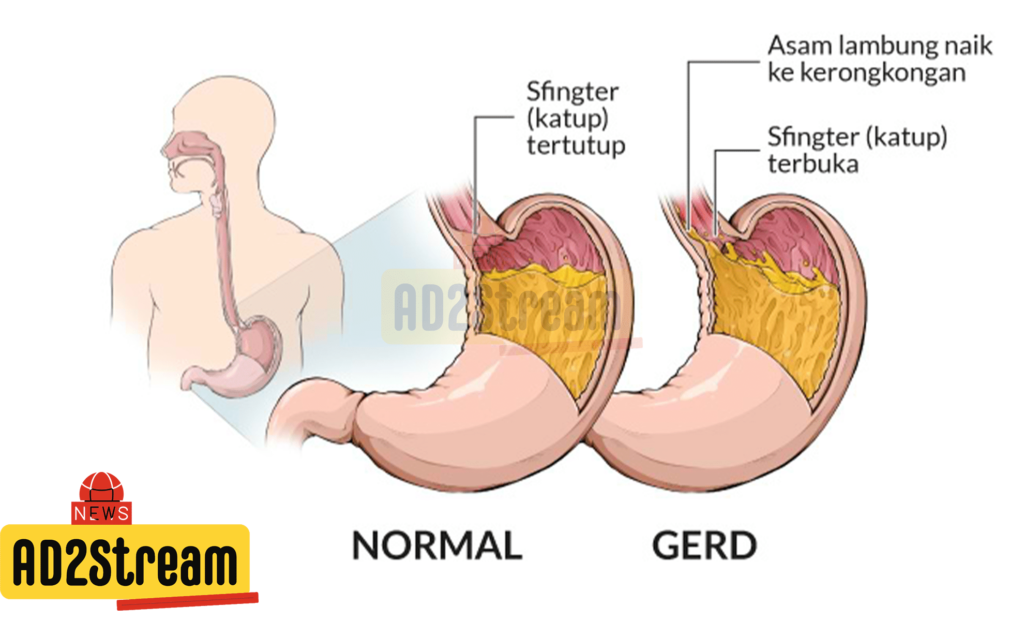 tips dan pencegahan yang dapat membantu Anda mengatasi asam lambung